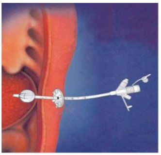Balloon gastrostomy.png