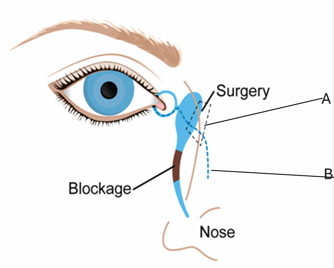 diagram showing the opening location in the lacrimal sac.png