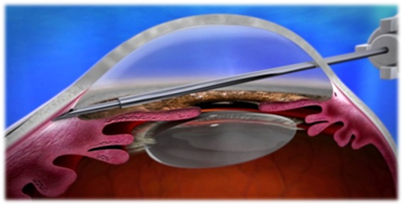 insertion of XEN gel stent into the eye (1).png
