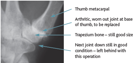 arthritis thumb base joint.png