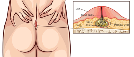 Drawing showing an oval of red skin above the buttocks. A cutaway diagram shows a cross section of the lump, with a space marked 'pilonidal cyst' under the skin, containing hair and fluid. A duct from the cyst through the lump is labelled 'sinus tract'.